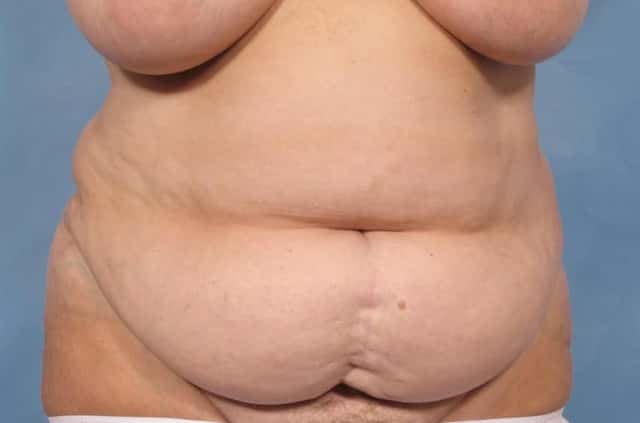 Tummy Tuck Before & After Case 115 before