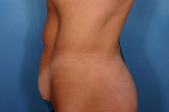 Tummy Tuck Before & After Case 116 before