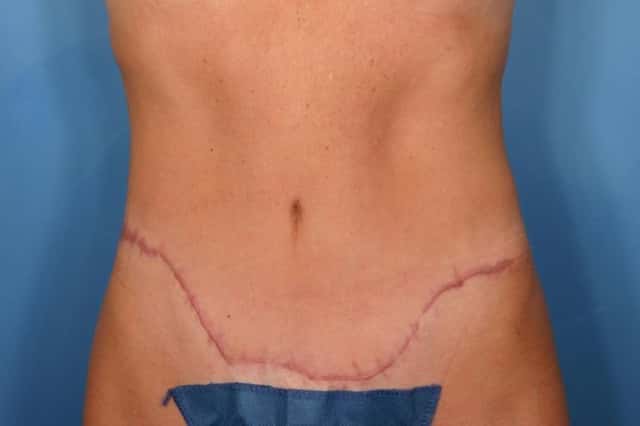 Tummy Tuck Before & After Case 116 after