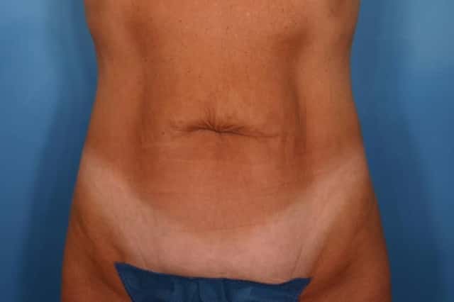 Tummy Tuck Before & After Case 116 before