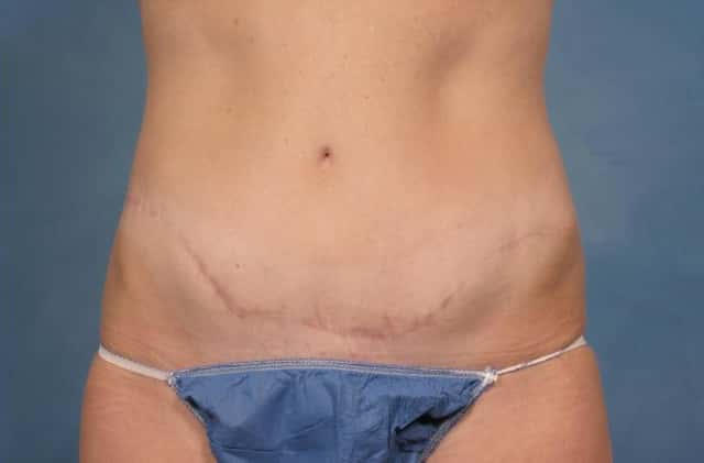 Tummy Tuck Before & After Case 116 after