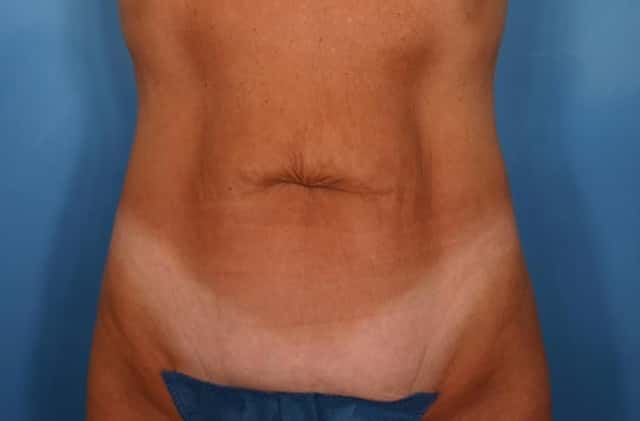 Tummy Tuck Before & After Case 116 before