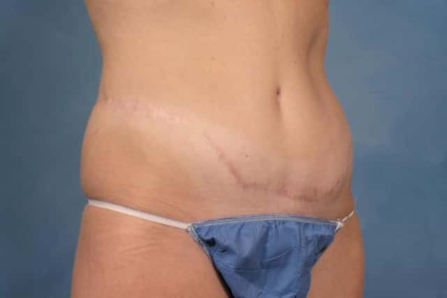 Tummy Tuck Before & After Case 116 after
