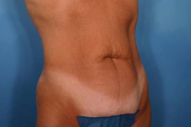Tummy Tuck Before & After Case 116 before