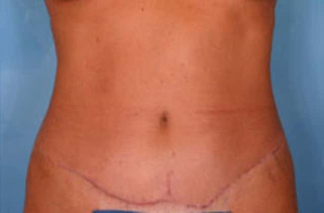 Tummy Tuck Before & After Case 16 after