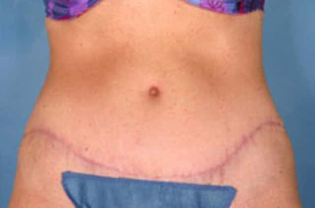 Tummy Tuck Before & After Case 17 after