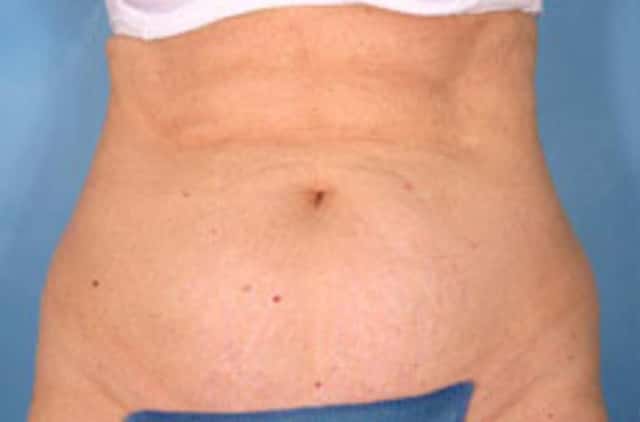 Tummy Tuck Before & After Case 17 before