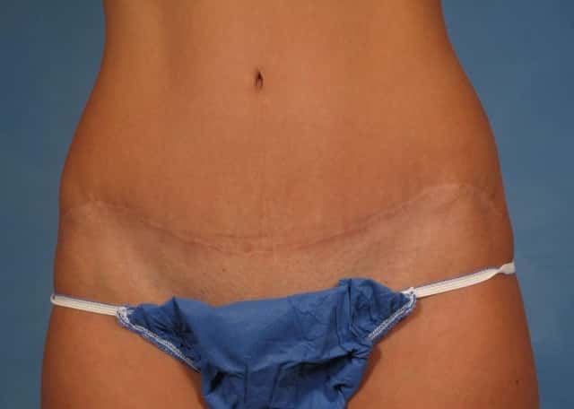 Tummy Tuck Before & After Case 170 after