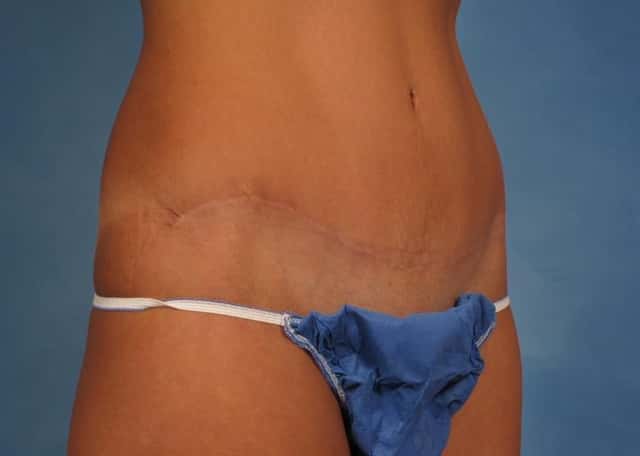 Tummy Tuck Before & After Case 170 after