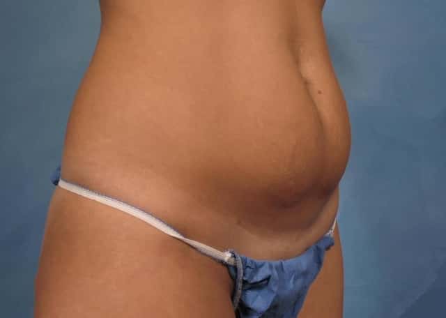 Tummy Tuck Before & After Case 170 before