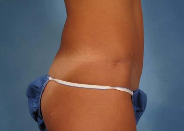Tummy Tuck Before & After Case 170 after