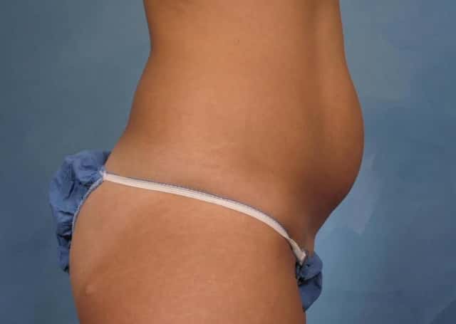 Tummy Tuck Before & After Case 170 before