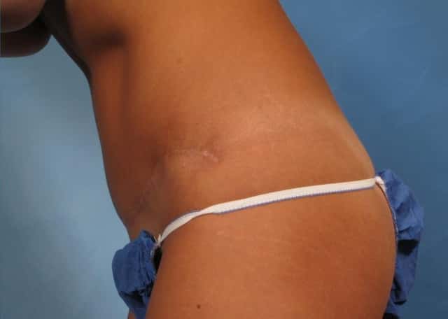 Tummy Tuck Before & After Case 170 after