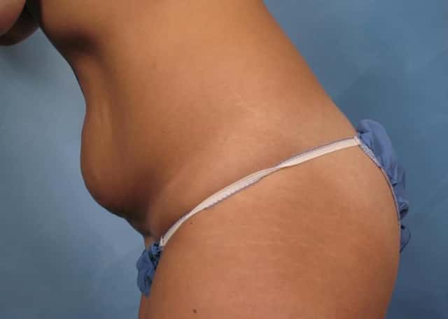 Tummy Tuck Before & After Case 170 before