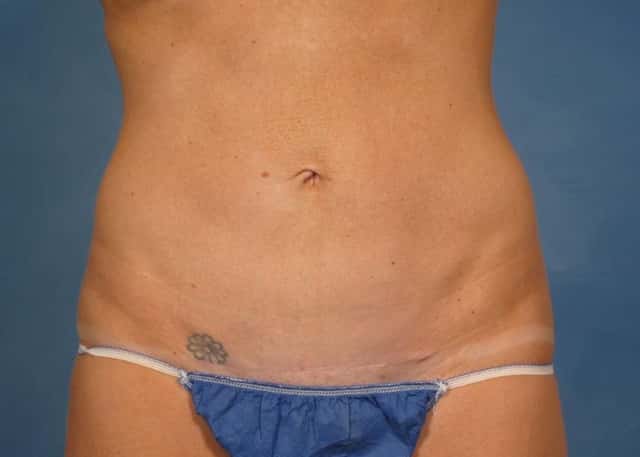 Tummy Tuck Before & After Case 171 after