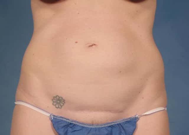Tummy Tuck Before & After Case 171 before