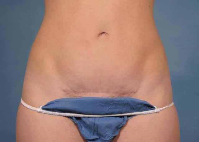 Tummy Tuck Before & After Case 172 after