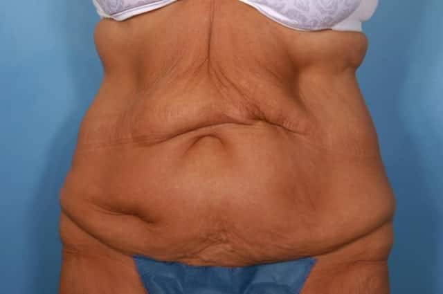 Tummy Tuck Before & After Case 21 before