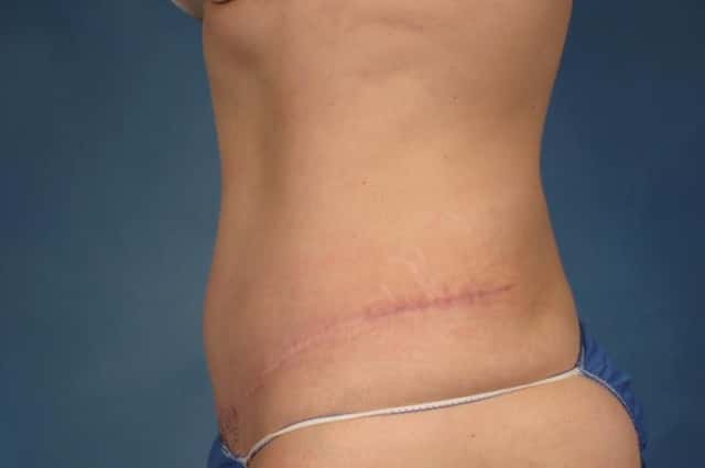 Tummy Tuck Before & After Case 234 after