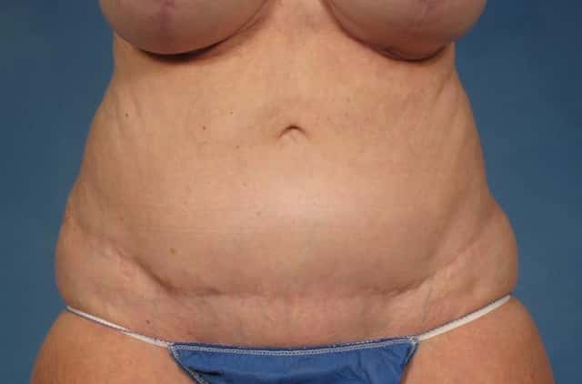 Tummy Tuck Before & After Case 245 after