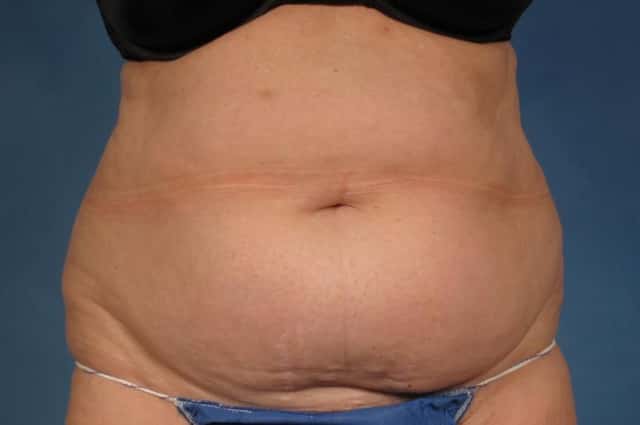 Tummy Tuck Before & After Case 257 before
