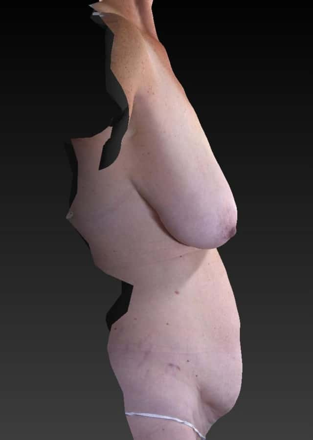 Tummy Tuck Before & After Case 313 before