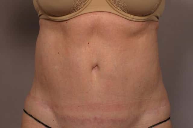 Revision Tummy Tuck and Liposuction of the love handles after