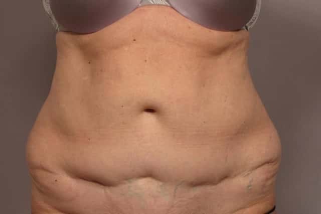 Revision Tummy Tuck and Liposuction of the love handles before