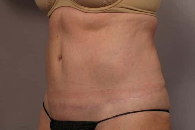 Revision Tummy Tuck and Liposuction of the love handles after