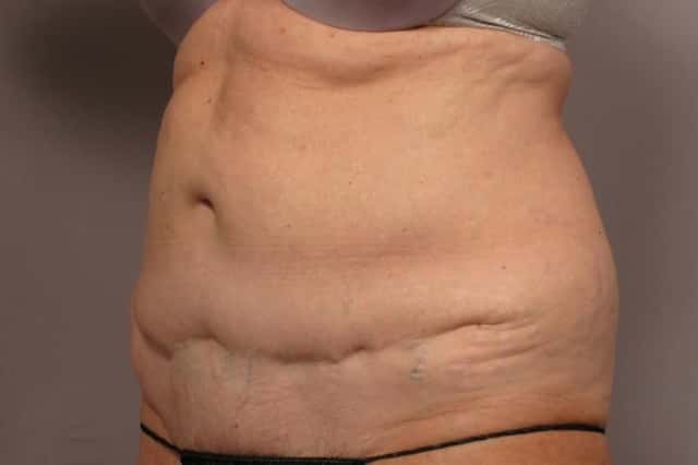 Revision Tummy Tuck and Liposuction of the love handles before