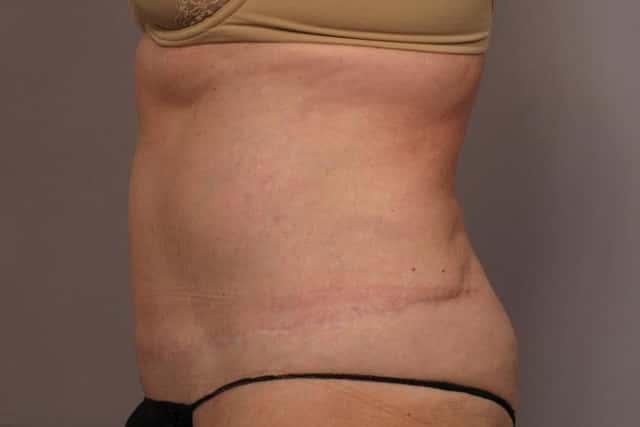 Revision Tummy Tuck and Liposuction of the love handles after