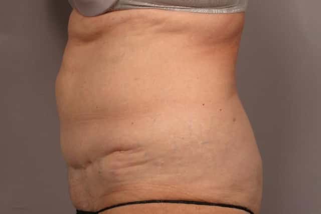Revision Tummy Tuck and Liposuction of the love handles before