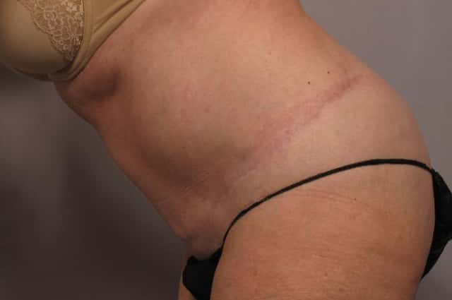 Revision Tummy Tuck and Liposuction of the love handles after