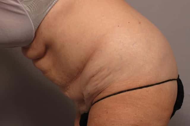 Revision Tummy Tuck and Liposuction of the love handles before