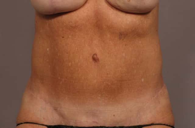 Tummy Tuck in a 68 year Old Naples, Florida Woman after