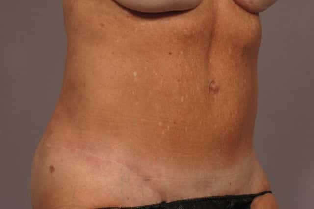 Tummy Tuck in a 68 year Old Naples, Florida Woman after