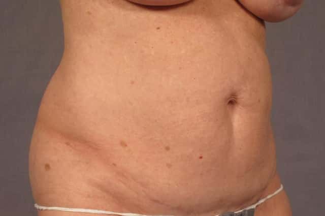 Tummy Tuck in a 68 year Old Naples, Florida Woman before