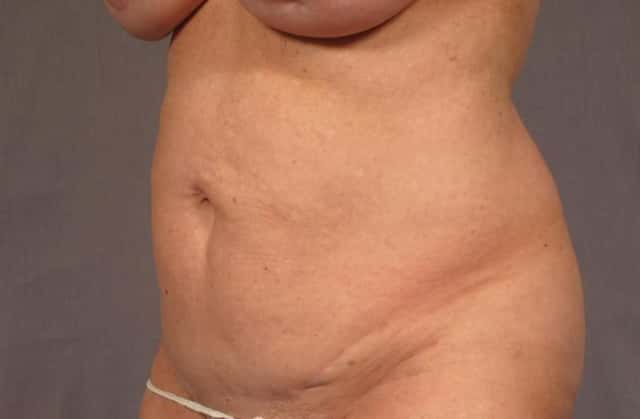 Tummy Tuck in a 68 year Old Naples, Florida Woman before