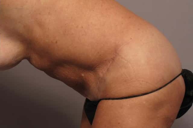 Tummy Tuck in a 68 year Old Naples, Florida Woman after