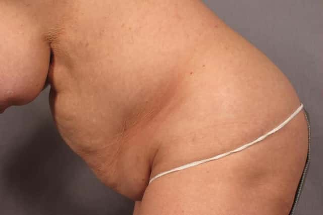 Tummy Tuck in a 68 year Old Naples, Florida Woman before
