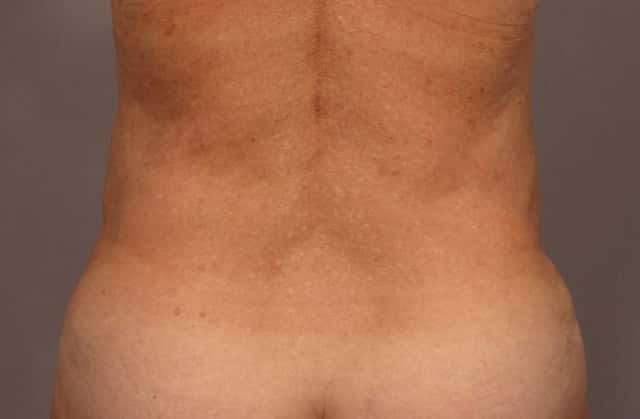 Tummy Tuck in a 68 year Old Naples, Florida Woman after