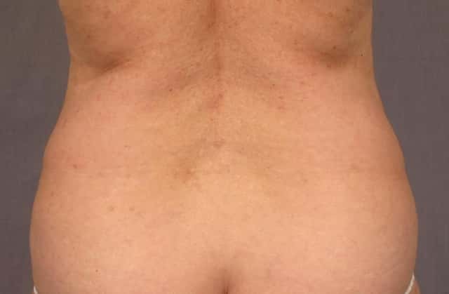 Tummy Tuck in a 68 year Old Naples, Florida Woman before