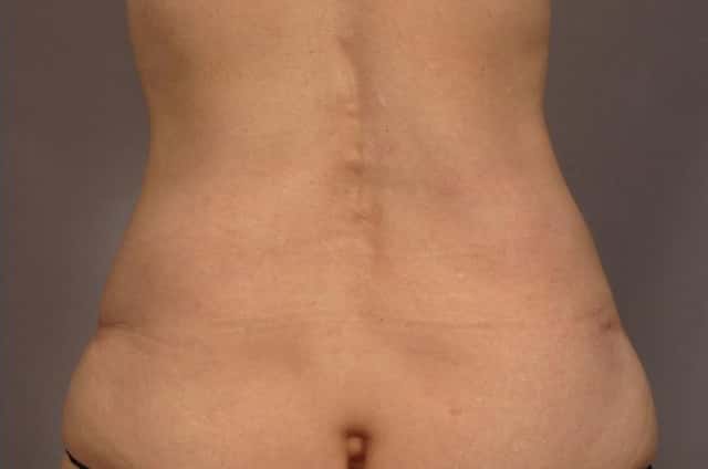 Tummy Tuck (Abdominoplasty) Before and 3 years after, Posterior View