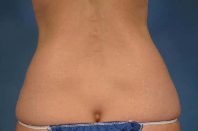Tummy Tuck (Abdominoplasty) Before and 3 years after, Posterior View