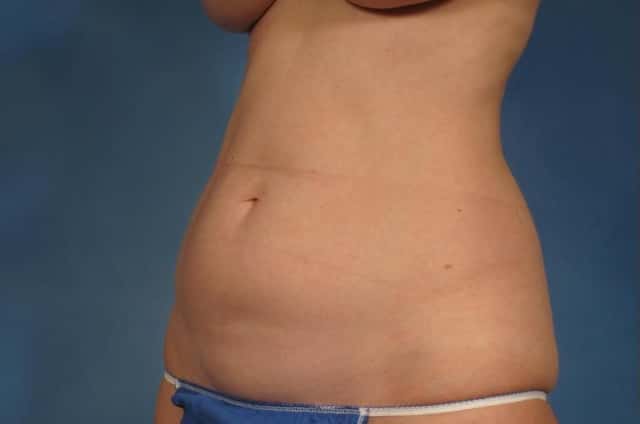 Tummy Tuck (Abdominoplasty) Before and 3 years after, Left Oblique View