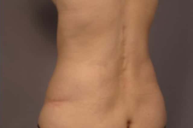 Tummy Tuck (Abdominoplasty) Before and 3 years after, Left Posterior Oblique View
