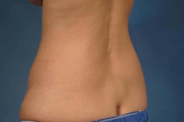 Tummy Tuck (Abdominoplasty) Before and 3 years after, Left Posterior Oblique View