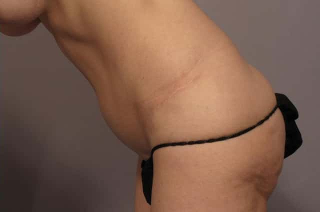 Tummy Tuck (Abdominoplasty) Before and 3 years after, Left Side - Bend Over View