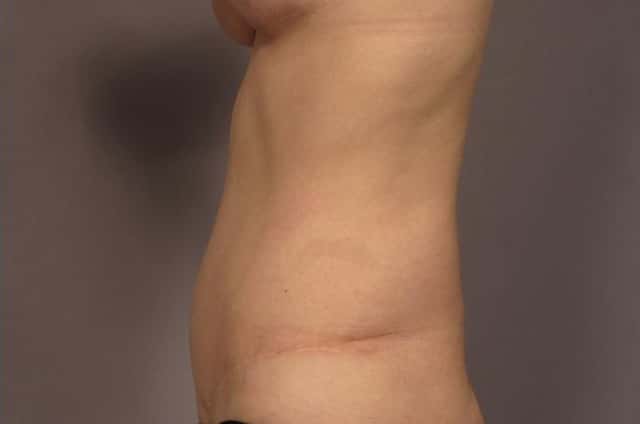 Tummy Tuck (Abdominoplasty) Before and 3 years after, Left Side View