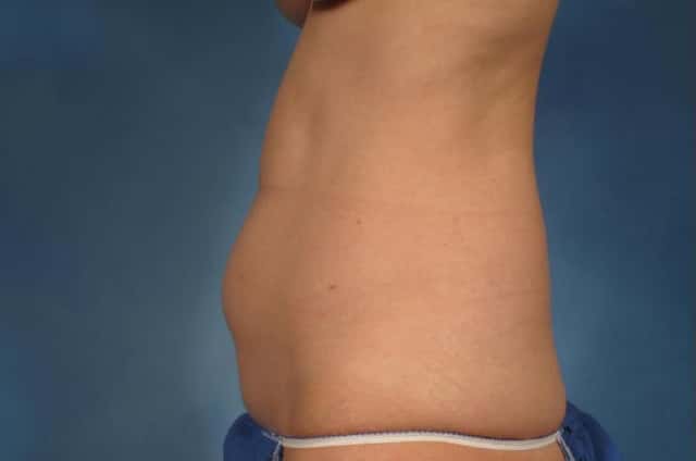 Tummy Tuck (Abdominoplasty) Before and 3 years after, Left Side View